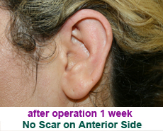 plastic-surgery-prominent-ear 